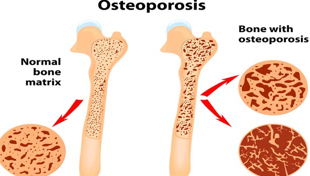 201605281305524868 Osteoporosis is caused due to what SECVPF