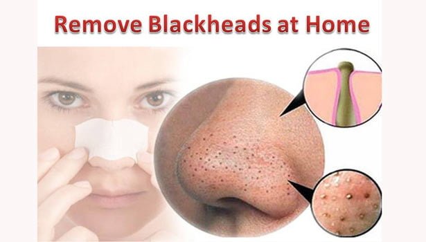 201708231420276499 1 blackheads. L styvpf