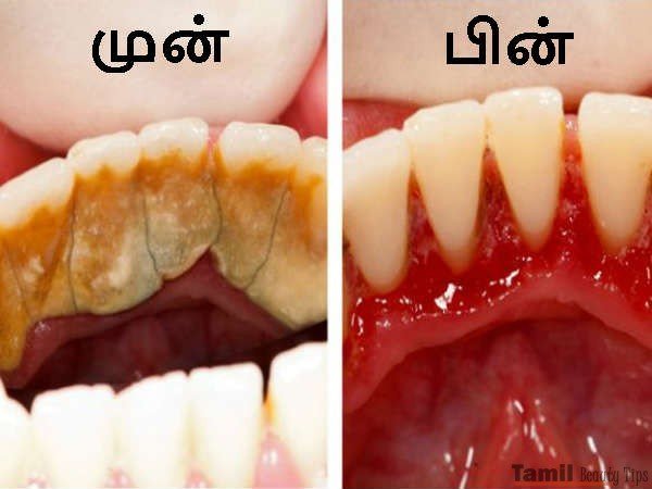 tooth plaque