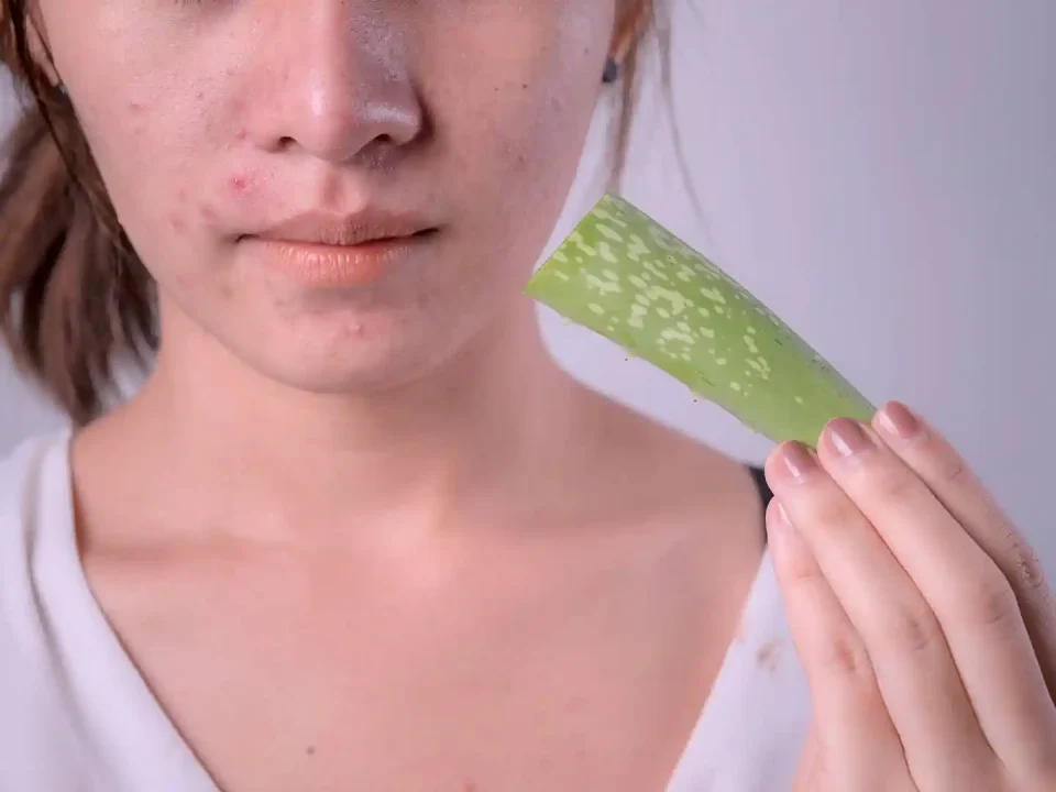 Aloe Vera for Acne Scars 1