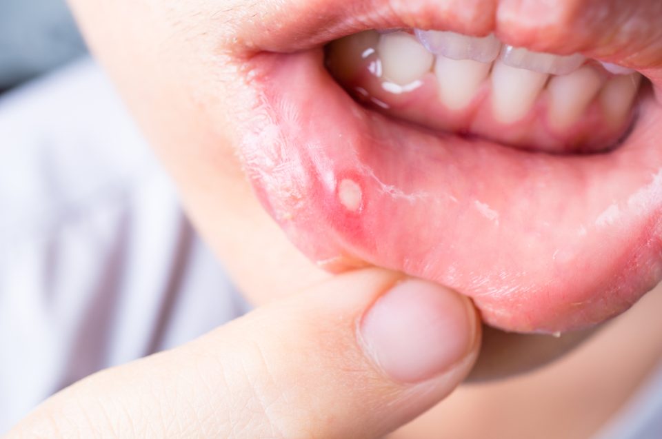 mouth ulcer