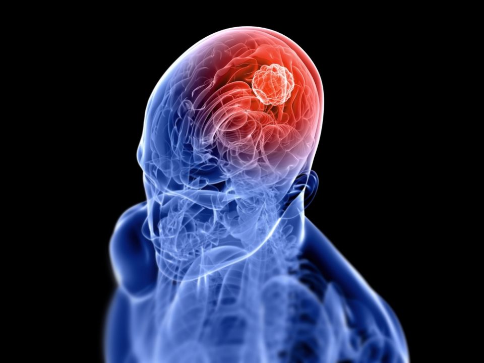 brain tumor blog photo