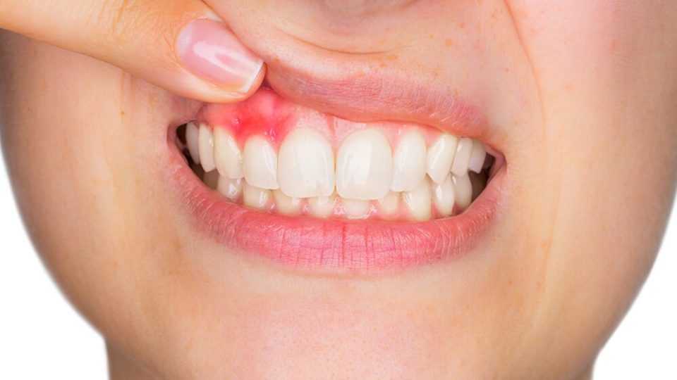 Swelling of the Gums