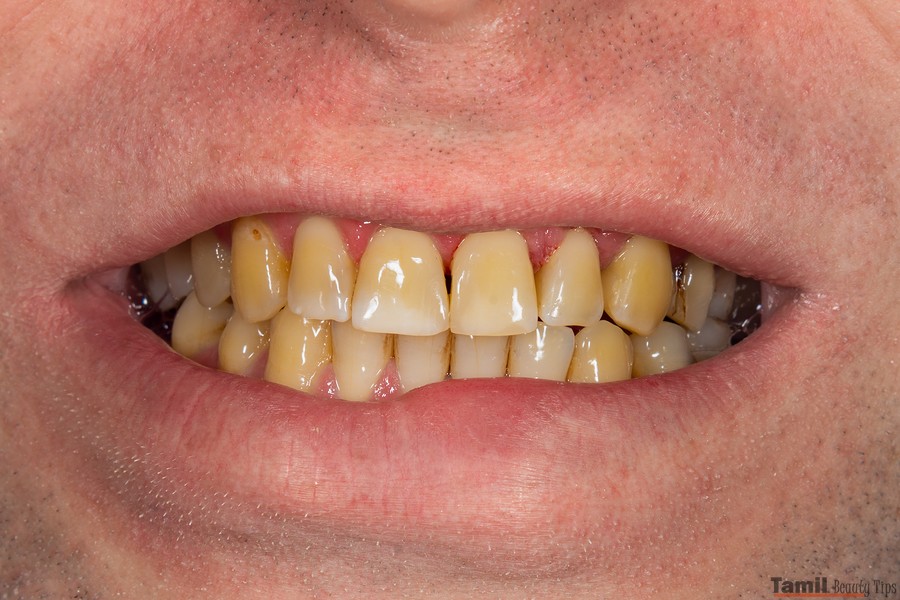 yellow stains on teeth