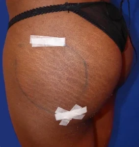 Patient After Buttock Injections