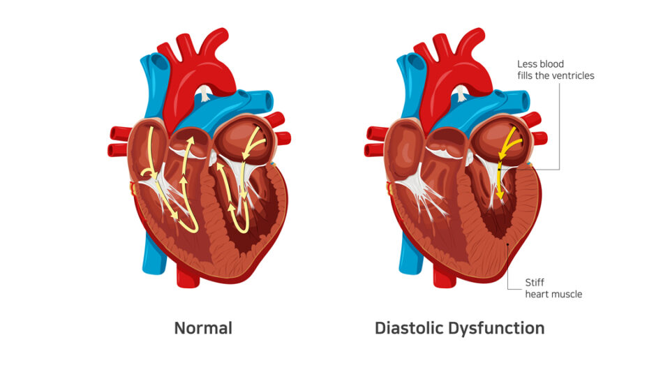 grade 1 diastolic dysfunction