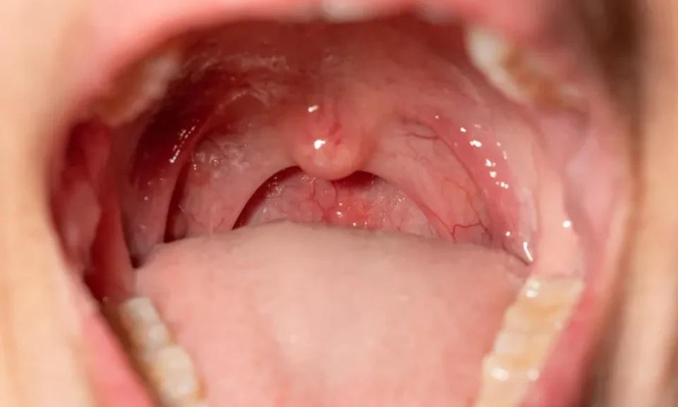 Swollen Tonsils alt 2