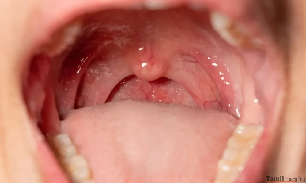 Swollen Tonsils alt 2
